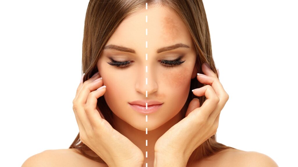 Natural Ways to Reduce Dark Spots and Pigmentation